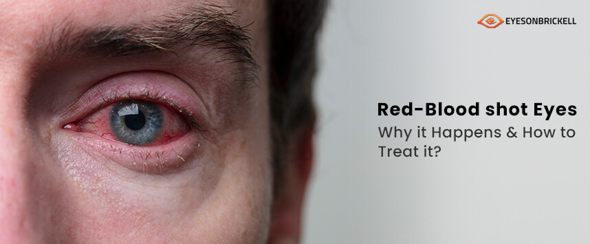 Eyes on Brickell: Red Eyes: Causes & Remedies