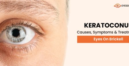Eyes on Brickell: Keratoconus Causes, Symptoms and Treatments