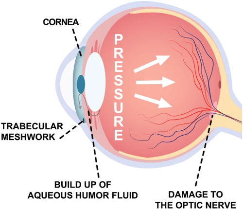 Eyes on Brickell: Glaucoma Eye