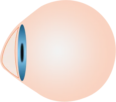 Eyes on Brickell: Keratoconus Eye